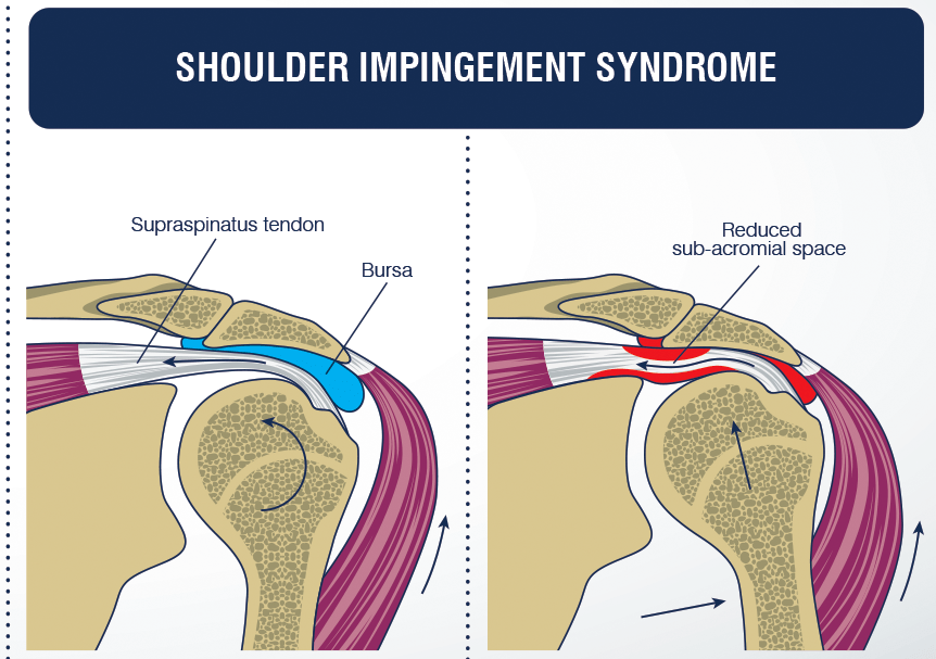 shoulder-impingement-kelley-spine-sport-chiropractic