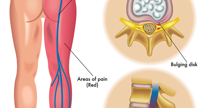 Sciatic Nerve Pain